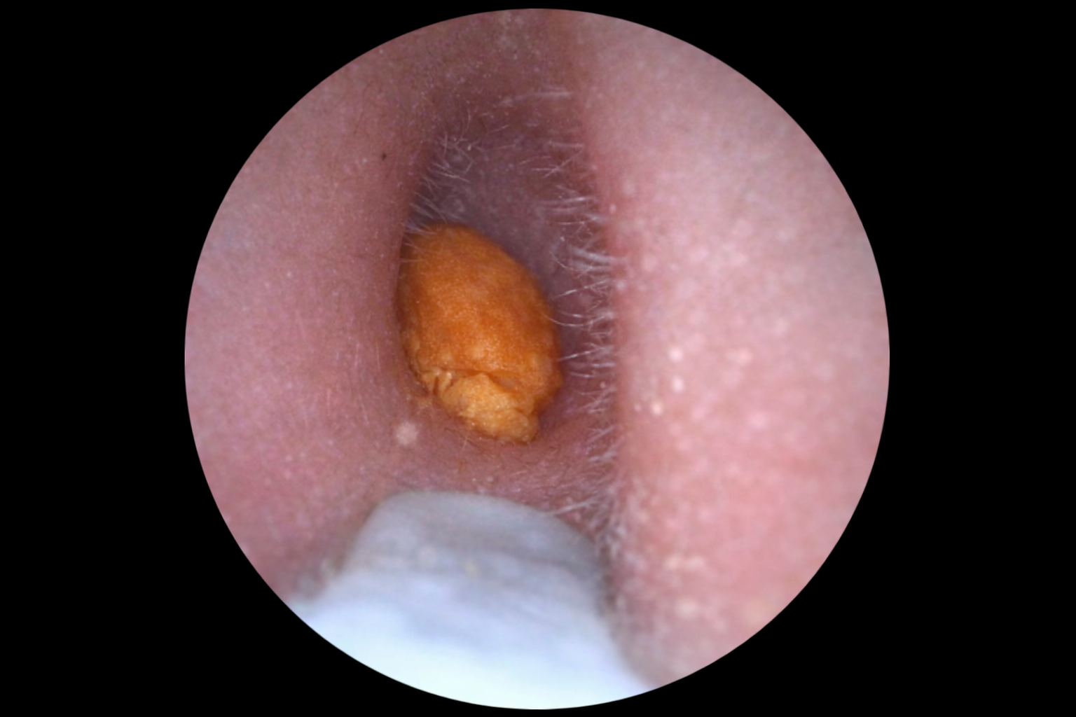 files/Inuti_oronkanalen_med_earwax.png